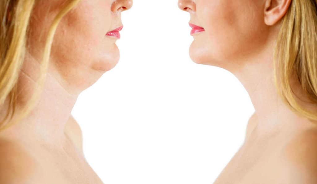 Double Chin treatment Hemel Hempstead before and after results