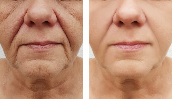 Learn more about Morpheus8 Treatment Hemel Hempstead today!