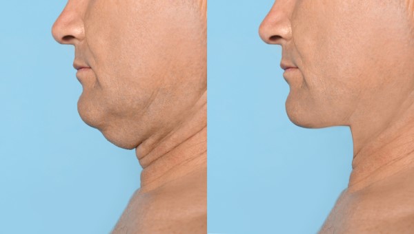 Which Non-Surgical Treatments Work Best for Jowls and Loose Skin Hemel Hempstead?