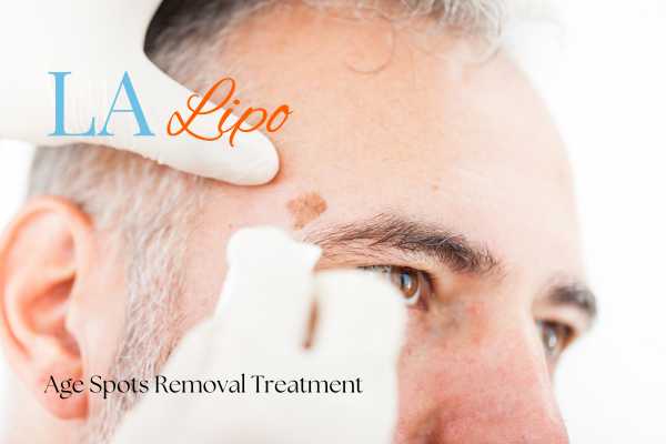 What Are the Most Effective Treatments for Age Spots Hemel Hempstead?
