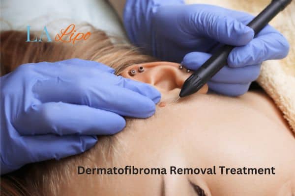 Dermatofibroma Removal Treatment Hemel Hempstead