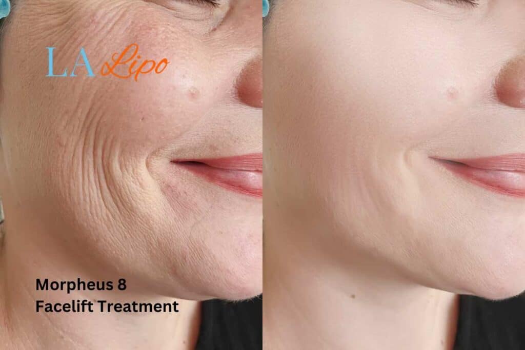 Morpheus8 Treatment Hemel Hempstead for flawless skin! Call us today!