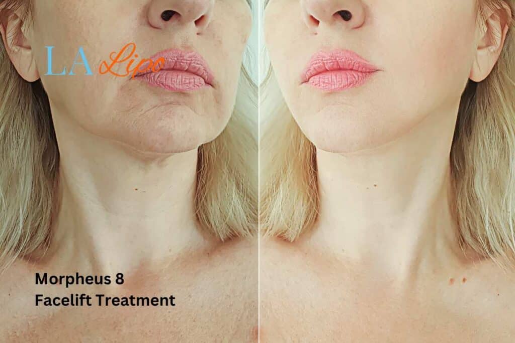 Turn back time with Morpheus8 Treatment Hemel Hempstead