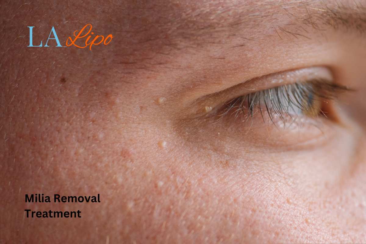 Cryopen Milia Removal: Is It the Easiest and Safest Option Hemel Hempstead?