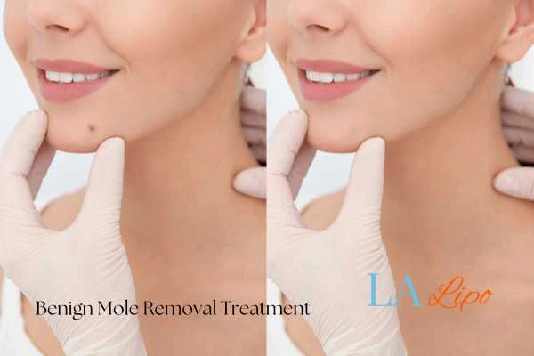 woman's before and after mole removal Hemel Hempstead results