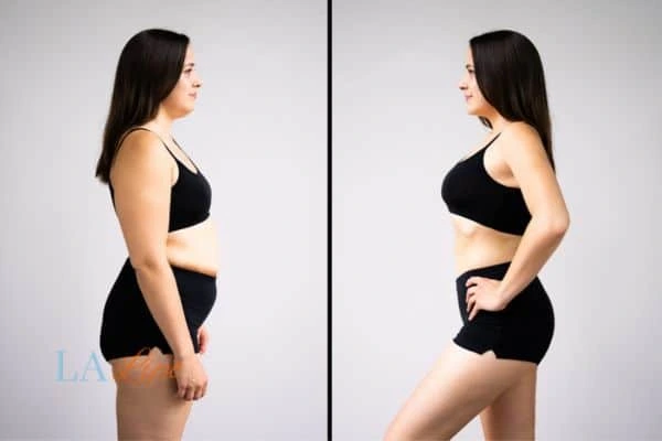 image of woman before and after results of LA-EMS Body Sculpting Hemel Hempstead to help treat Diastasis recti