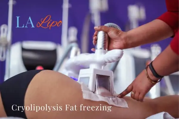 women getting fat freezing Hemel Hempstead