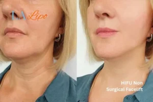 hi-fu for wrinkles Hemel Hempstead before and after results
