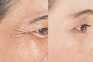 Before and after results of woman - HI-fu wrinkles reduction treatment Hemel Hempstead