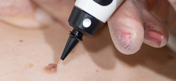 skin tag removal using cryopen Hemel Hempstead