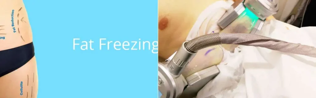 Fat freezing Hemel Hempstead on multiple areas of the body