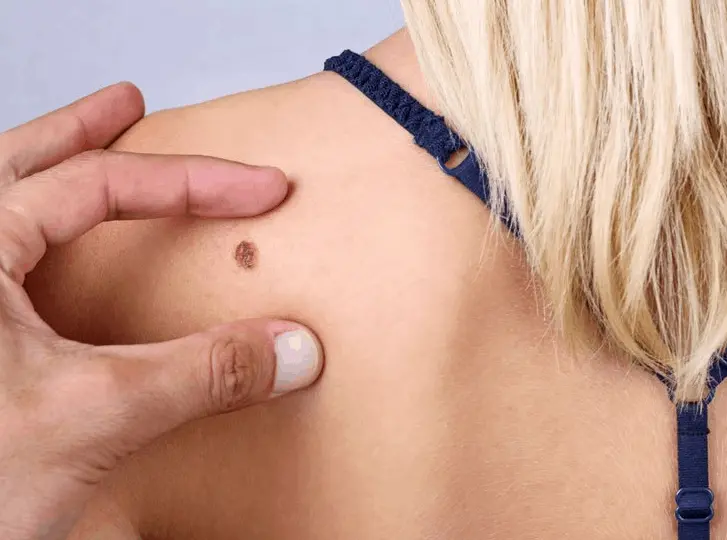 woman having mole removal Hemel Hempstead consultation before treatment.