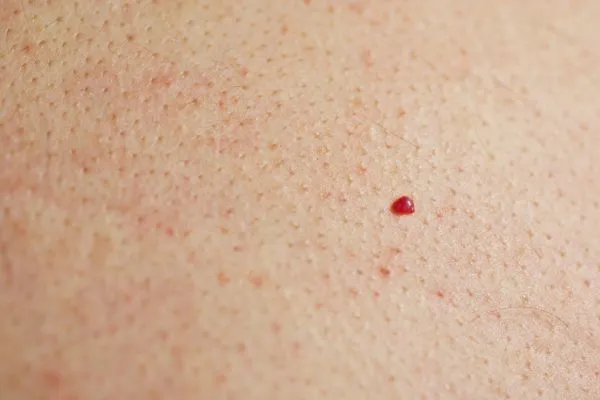 close up of a cherry angioma Hemel Hempstead
