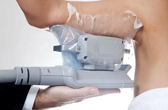Picture of fat freezing Hemel Hempstead on the upper arms.