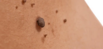 image of a skin tag Hemel Hempstead