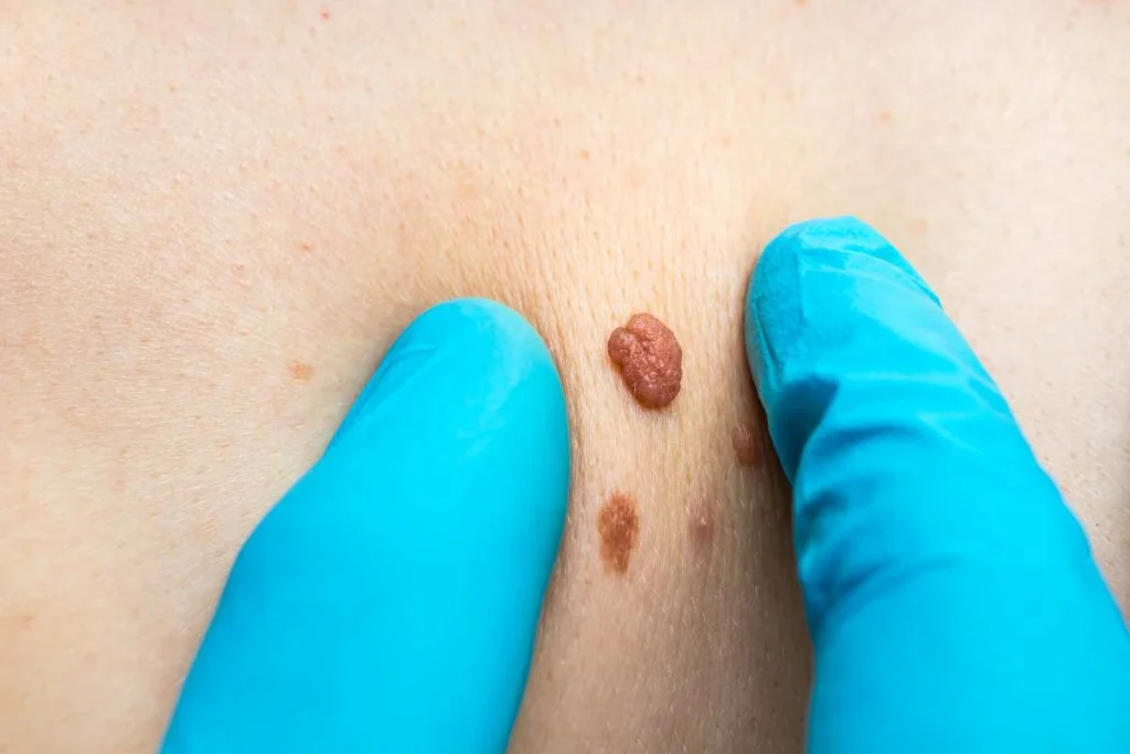 Consultant examining a skin tag Hemel Hempstead