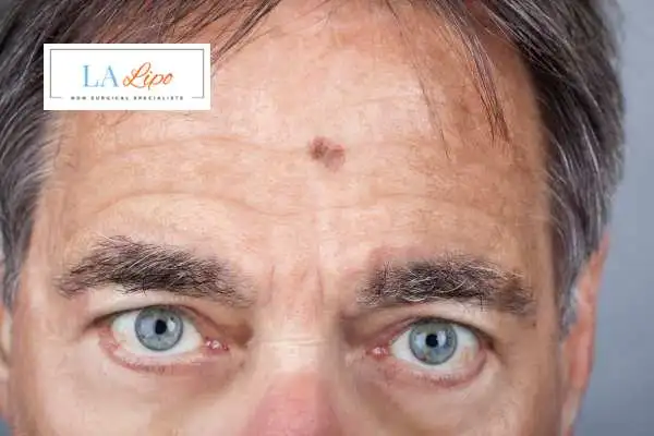 Solar Lentigo Removal Hemel Hempstead image of man with mark on his forehead