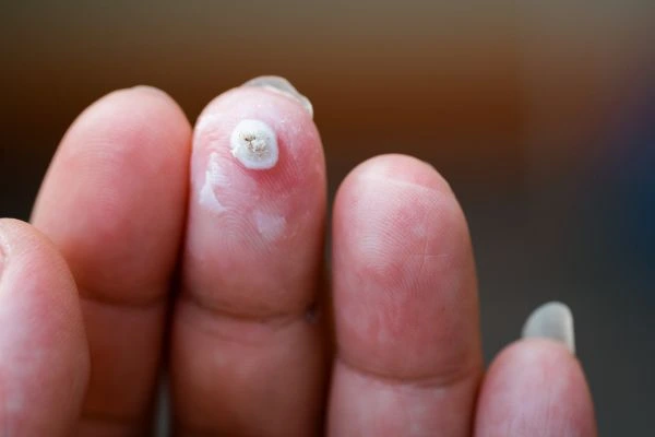 wart on person finger - cryotherapy to treat from LA LIPO Hemel Hempstead