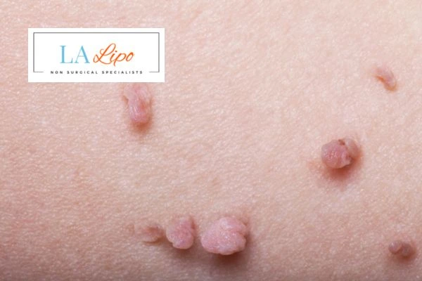 Does cryopen skin tag removal Hemel Hempstead hurt? Find out now call our team today!