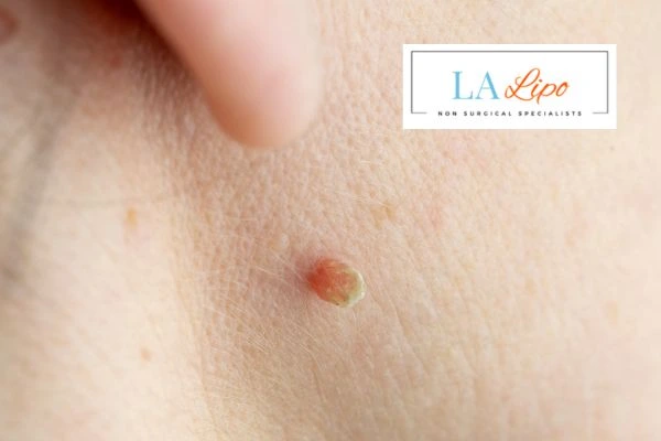 Book skin tag removal Hemel Hempstead today speak to our team now!