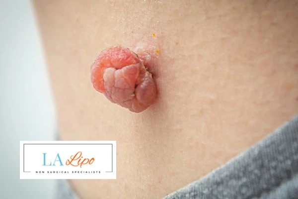 Interested in skin tag removal Hemel Hempstead? Concerned about the pain? Find out more today!
