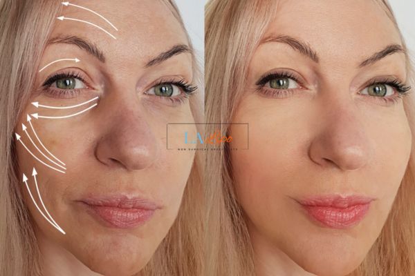 Morpheus 8 results Hemel Hempstead face lift.