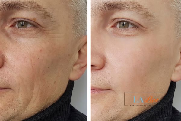 See the amazing results of Morpheus8 Treatment Hemel Hempstead!