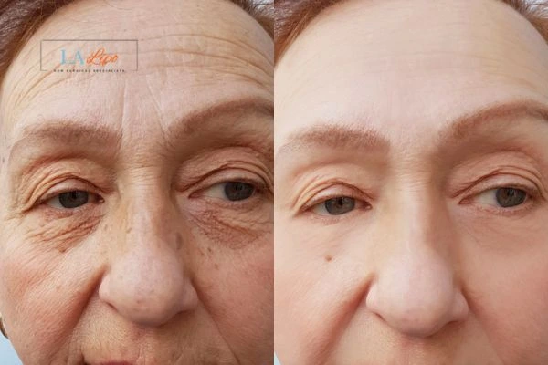 The powerful benefits of Morpheus8 Treatment Hemel Hempstead - Call Our team today!