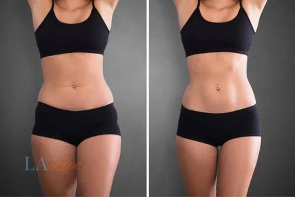 before and after results of non-surgical treatment to help a woman's body image and mental health Hemel Hempstead
