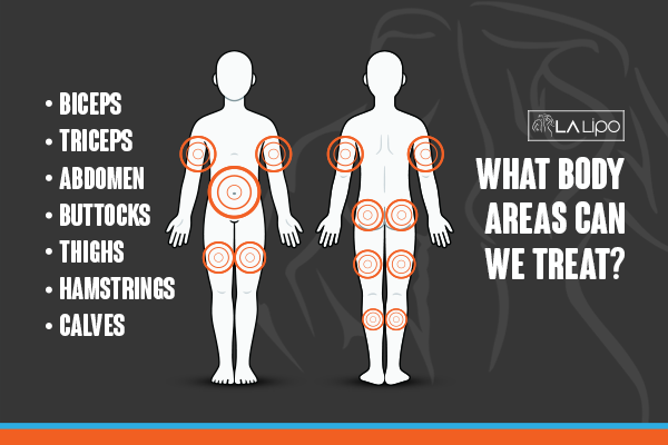 Diagram to show areas you can have LA-EMS Body Sculpting Treatment Hemel Hempstead