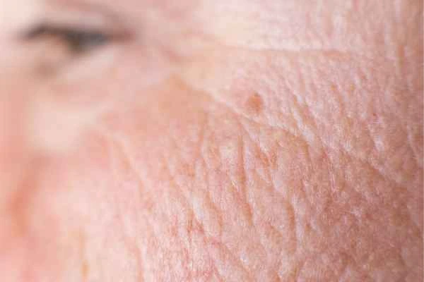 close up picture of a woman's face showing an age spot Hemel Hempstead