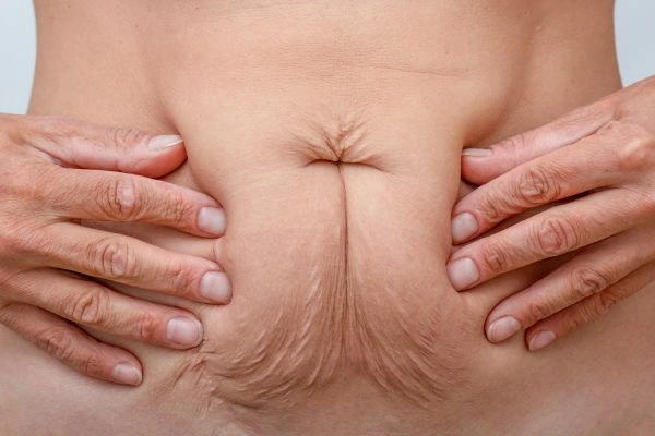 Image of a woman's stomach with loose skin - example of skin tightening Hemel Hempstead options