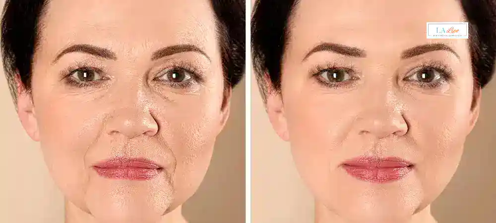 How Long Does It Take to See Results and How Long Do They Last Hemel Hempstead?