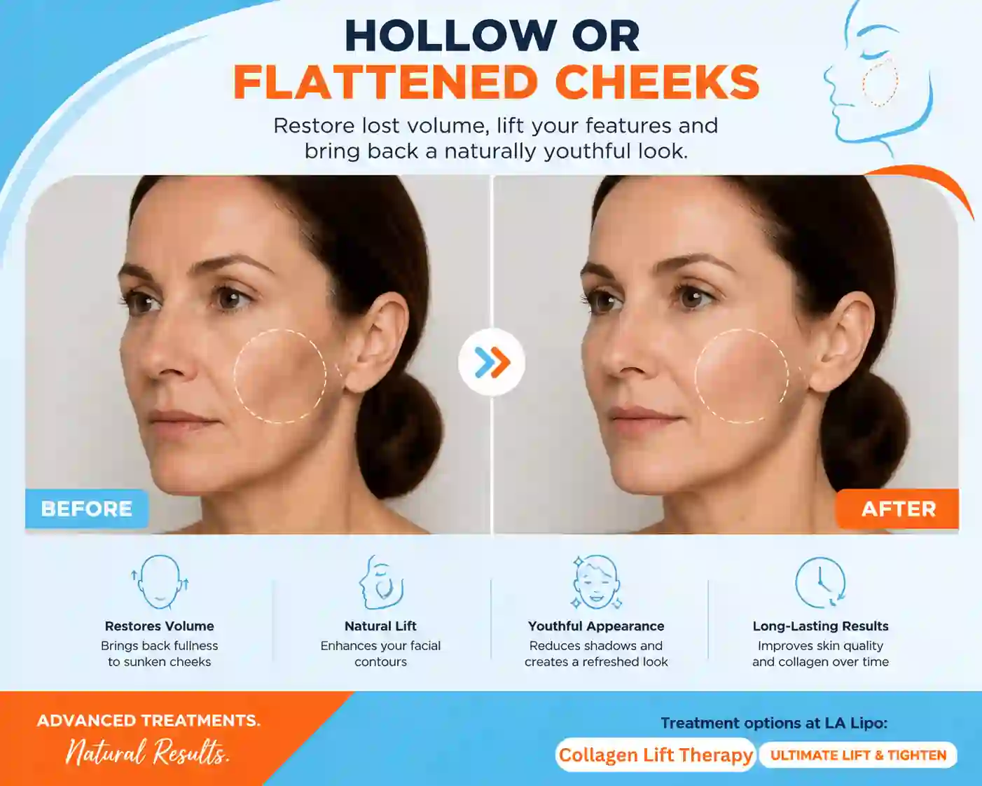 Sign #4: Hollow or Flattened Cheeks Hemel Hempstead