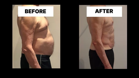 What Symptoms Can Diastasis Recti Cause in Men? Weak Core, Back Pain and Poor Posture Hemel Hempstead